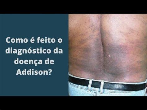 Doença de Addison: Sintomas, Diagnóstico e。